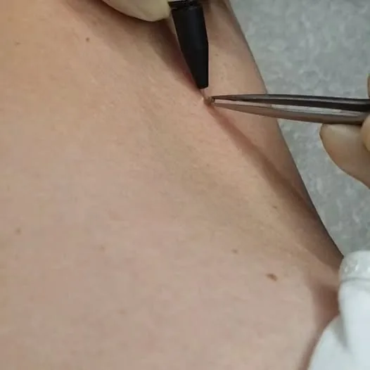 Elektrokoagulacija prethodno dijagnosticirane virusne bradavice